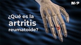 Artritis Reumatoide  ExclusivoMSP [upl. by Keyte]