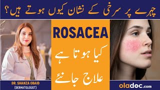 Rosacea Treatment  Rosacea Kya Hota Hai  Chehre Pe Surkhi Ka Ilaj  How To Get Rid Of Face Redness [upl. by Nnaarat]