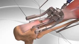 Achilles Tendon Rupture Repair with Arthrex® PARS System [upl. by Urban]