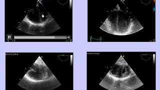 ACUTE COR PULMONALE IN MV PATIENT CAUSES TREATMENTS THERAPIES A VieillardBaron [upl. by Cline]