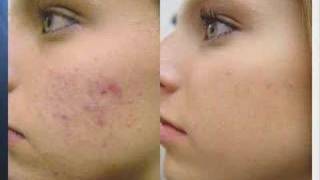 Acne Treatment with Fotona Laser [upl. by Eilssel]