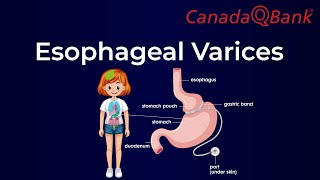 Esophageal Varices [upl. by Zannini]