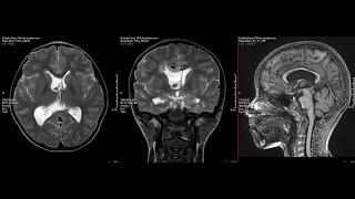 Tumor Ventricular Oligodendroglioma [upl. by Nerti928]