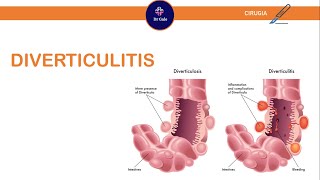 Diverticulitis ParaelENARM [upl. by Piselli]