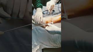 Cruciate ligament repair ligament surgery  mozart peroneus longus [upl. by Ariela26]