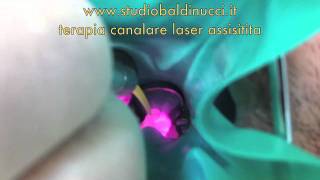 Terapia canalare laser assistitam4v [upl. by Rodina182]