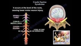 Cauda Equina Syndrome  Everything You Need To Know  Dr Nabil [upl. by Diva]