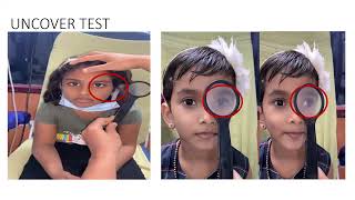 Strabismus by Dr Remya Edachery MVUPGO [upl. by Aminta]