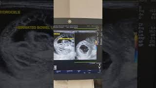 Inguinoscrotal Hernia With Hydrocele Ultrasound [upl. by Ellevehc977]