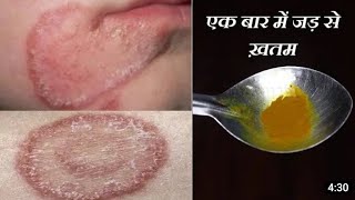 fungal infection  treatment for fungal infection  skin infection treatment  itching treatment [upl. by Ahtnamas]