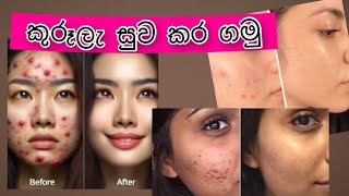 කුරූලෑ සුව කර ගමු💜  👉how to remove pimple 💧👩‍🔬 නිවසේදි 🏡කල හැකි ප්‍රතිකාර🏞 nvq level 4 [upl. by Saalocin396]