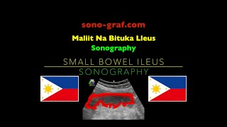 Sonography  Maliit Na Bituka aLleus [upl. by Namrak]