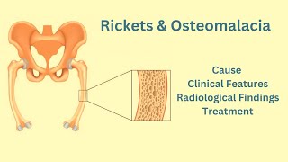 Rickets amp Osteomalacia Causes Clinical features Radiological features Treatment [upl. by Leid]