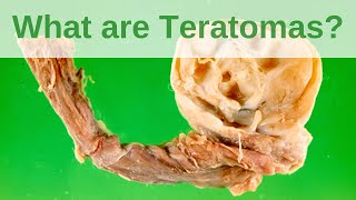 What are Teratomas  Pathology mini tutorial [upl. by Benetta]