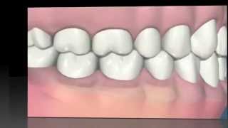 Gingivitis y Periodontitis [upl. by Enirehtac]