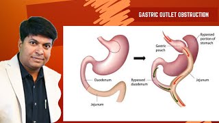 Gastric Outlet Obstruction  Presentation Complications and Management  Dr Rajamahendran rrm [upl. by Soisinoid862]