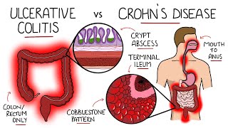 Inflammatory Bowel Disease  Ulcerative Colitis v Crohns Disease With Histology amp Manifestations [upl. by Esil]