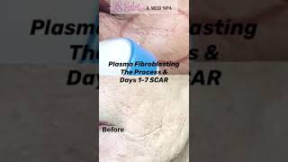 Plasma Fibroblasting SCAR Days 17 [upl. by Clarie]