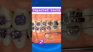 Impacted tooth during Braces [upl. by Roleat]