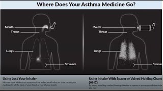 Spacer Use for Asthma Inhaler [upl. by Eyk]