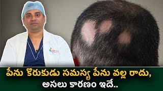 Alopecia areata Symptoms Causes and Treatment  Treatment for Alopecia Areata  Hair Loss treatment [upl. by Janus]