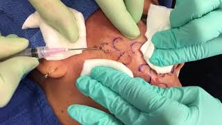 Subcision at Sanova Dermatology [upl. by Suzetta]