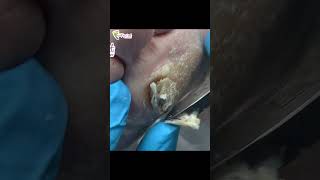 FULL VIDEO in description healthyfeet podiatry podiatrist feetcare callus callusremoval [upl. by Limaj]