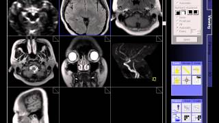 BRAIN MRI NORMAL [upl. by Enialahs792]