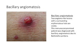 Bacillary angiomatosis [upl. by Amrita]