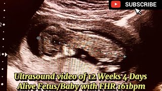 Ultrasound video of 12 Weeks 4 Days Alive FetusBaby with FHR 161bpm [upl. by Sirahs]