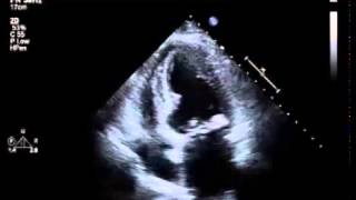 TheEchoWeb  Aortic Stenosis and Mitral Annulus Calcification [upl. by Ruyle]