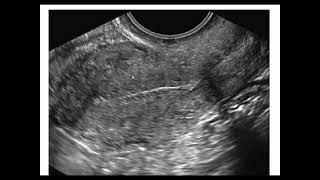 Assessment of endometrium by ultrasonography [upl. by Elene574]