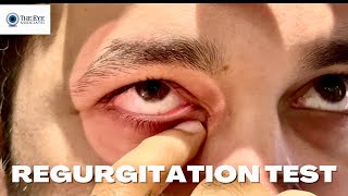 Regurgitation Test Lacrimal System Examination [upl. by Wrdna883]