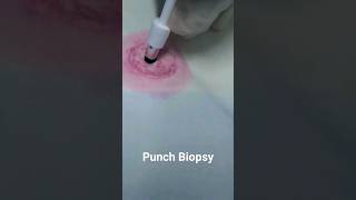 Punch Biopsy Technique doctor hospital [upl. by Nnylkcaj298]