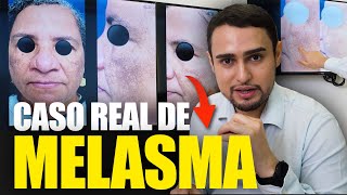 TRATAMENTO PARA MELASMA CASO REAL [upl. by Acisse581]