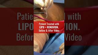 Amazing Patient Results after Liposuction amp Renuvion [upl. by Andrien314]