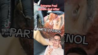 TW😱 SHOCKING CHEMICAL PEEL  Phenol Peel Before and After shorts [upl. by Hayton]