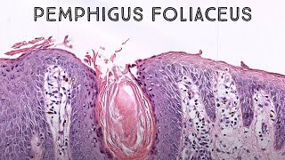 Pemphigus foliaceus autoimmune skin blister immunobullous disease in pemphigus vulgaris family [upl. by Jacy419]