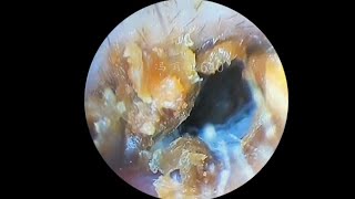 采耳哥Cleaning moldy earwax [upl. by Denise]