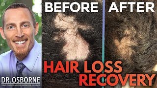 Can hair loss be reversed naturally [upl. by Savinirs705]