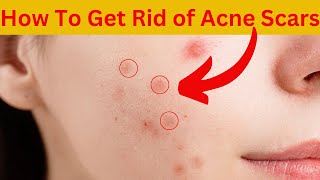 Youve Been Treating Acne Scars WRONG All Along [upl. by Gnouv]