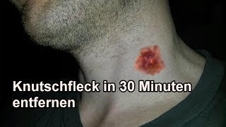 Knutschflecken mit Mundwasser in 30 Min entfernen  Knutschfleck schnell wegbekommen  Tutorial [upl. by Nwaf]