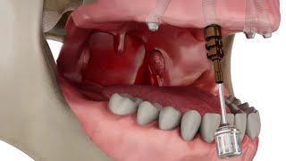 Straumann Pro Arch Step by Step Overview [upl. by Jessen]