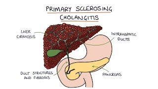 Primary Sclerosing Cholangitis Visual Explanation for Students [upl. by Ahsaela]