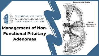 Management of NonFunctional Pituitary Adenomas [upl. by Christoffer]