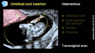 Velamentous insertion of the umbilical cord [upl. by Ahsirak]