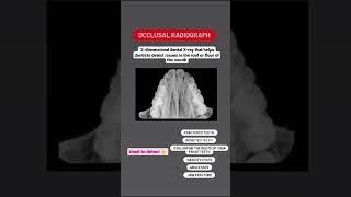 What is an Occlusal Radiograph [upl. by Art423]