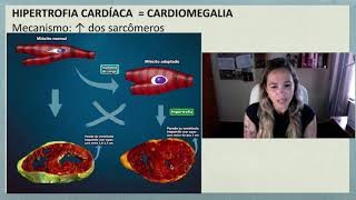 Hipertrofia Cardíaca  Cardiomegalia [upl. by Aninotna]