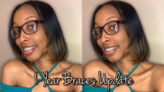 1 Year Braces Update  24hr Wear Elastic Rubber Bands  Powerchain Update  Overall Journey Thus Far [upl. by Supple]