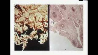 Histopathology JointRheumatoid arthritis [upl. by Noffihc]